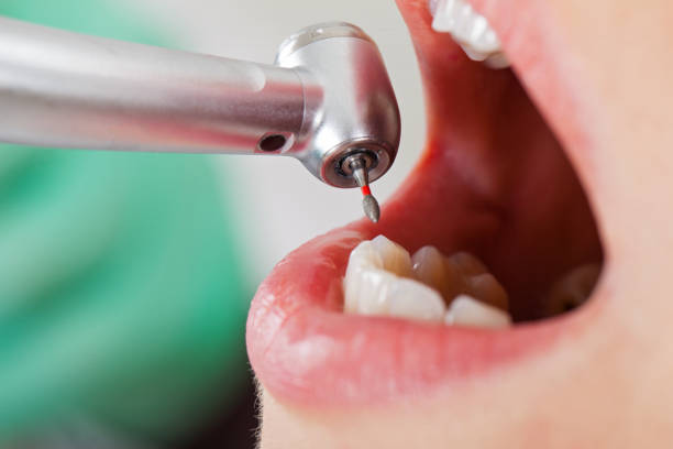 Best Emergency Root Canal Treatment in Greenville, RI